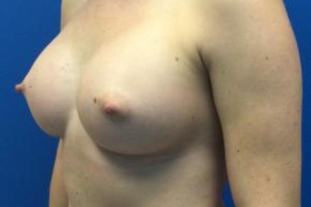 After image 2 Case #103246 - Silicone Breast Augmentation for a 36 year old female