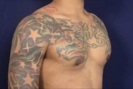 After image 2 Case #102466 - Gynecomastia