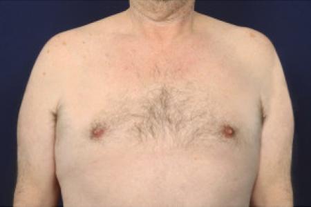 After image 1 Case #102621 - Gynecomastia 