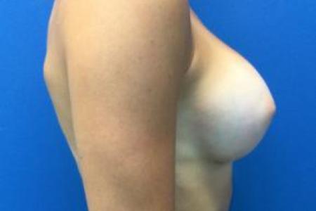 After image 3 Case #103326 - Silicone Breast Augmentation for a 27 year old female