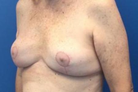 After image 2 Case #103266 - Bilateral Breast Implant Explantation for a 63 year old female