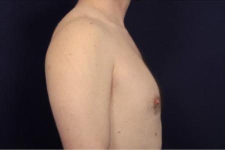 After image 3 Case #102646 - Gynecomastia
