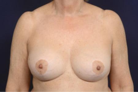 After image 1 Case #103106 - Fat Grafting of Breasts