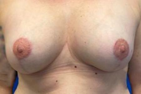 After image 1 Case #103276 - Silicone Breast Augmentation for a 38 year old female