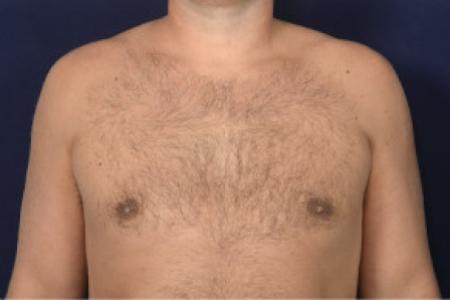 After image 1 Case #102446 - Gynecomastia