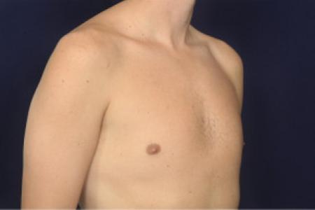 After image 2 Case #102491 - Gynecomastia