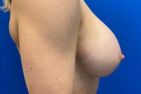 After image 3 Case #103291 - Silicone Gel Breat Augmentation for a 24 year old female