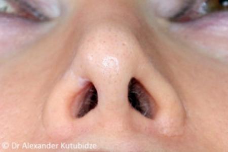 After image 6 Case #103351 - Revision Rhinoplasty. 3 years after