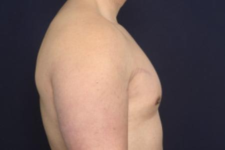 After image 3 Case #102526 - Gynecomastia