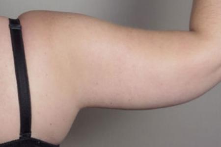 After image 4 Case #103136 - Upper Arm Lift 15