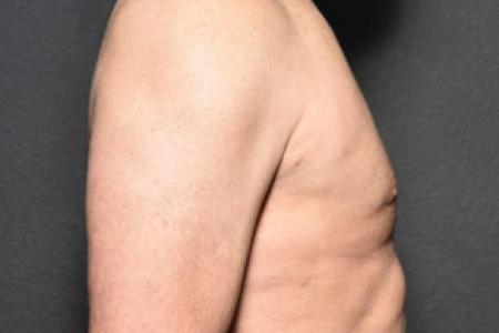 After image 2 Case #101616 - Gynecomastia