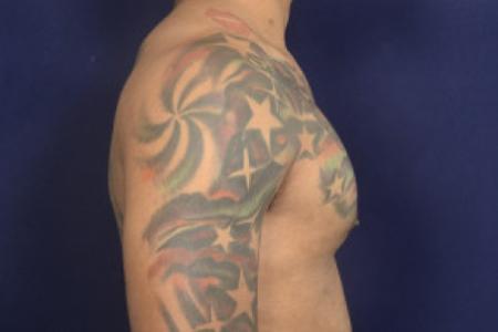 After image 3 Case #102466 - Gynecomastia