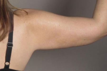 After image 2 Case #103191 - Upper Arm and tummy Liposuction Patient 13