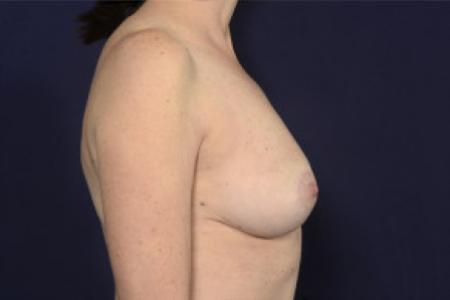 After image 3 Case #103091 - Fat Grafting of Breasts