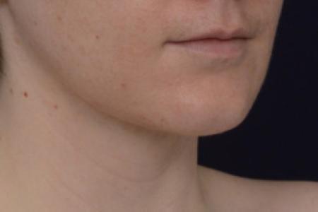 After image 2 Case #102801 - Neck Lift