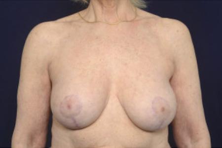 After image 1 Case #102511 - Breast Augmentation Revision