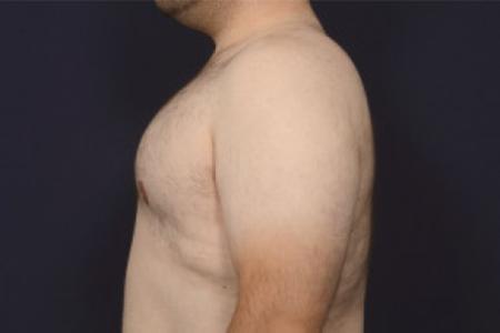 After image 3 Case #102626 - Gynecomastia