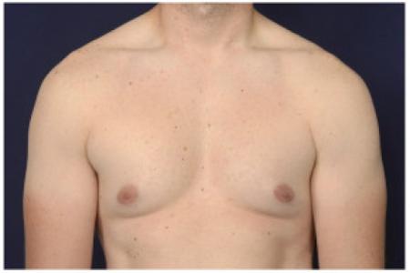 After image 1 Case #102351 - Gynecomastia