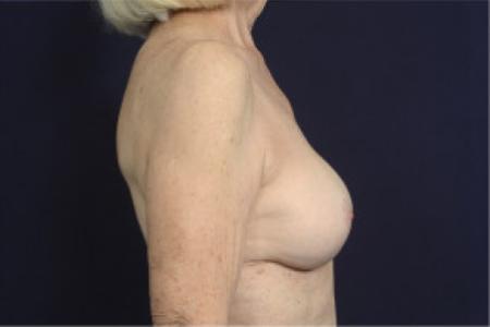 After image 3 Case #103056 - Breast Augmentation Revision