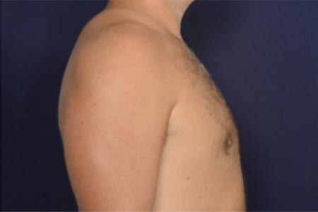 After image 3 Case #102446 - Gynecomastia