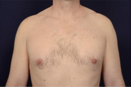 After image 1 Case #102646 - Gynecomastia