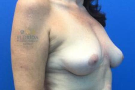 After image 2 Case #103336 - Removal of Implants with Fat Grafting to Breasts for a 50 year old female