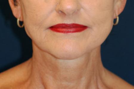 After image 1 Case #102781 - Lower Facial Rejuvenation