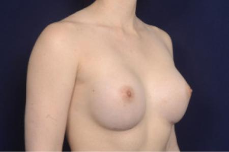After image 2 Case #102476 - Breast Augmentation