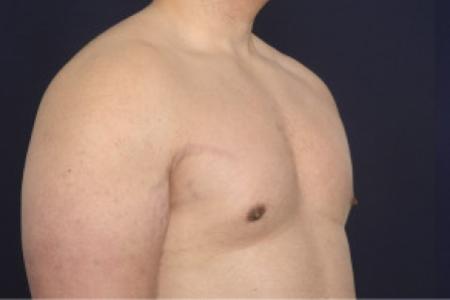 After image 2 Case #102526 - Gynecomastia