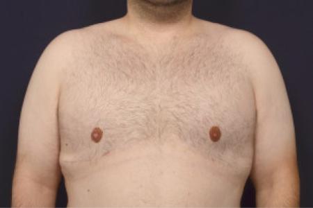 After image 1 Case #102626 - Gynecomastia