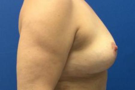 After image 2 Case #103281 - Breast Implant Explantation for a 42 year old female