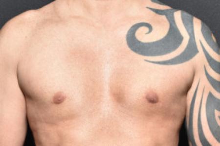 After image 1 Case #101616 - Gynecomastia