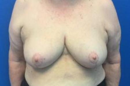 After image 1 Case #103301 - Breast Reduction Mammoplasty for a 70 year old female