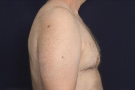 After image 3 Case #102426 - Gynecomastia