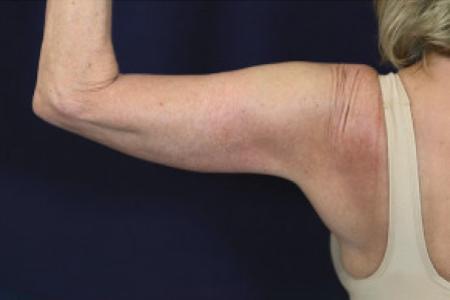 After image 2 Case #102401 - Brachioplasty