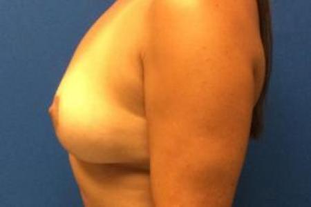 After image 3 Case #103271 - Bilateral Implant Explanation with En-Bloc Capsulectomies for a 44 year old female