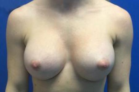 After image 1 Case #103286 - Silicone Gel Beast Augmentation Mammoplasty for a 28 year old female
