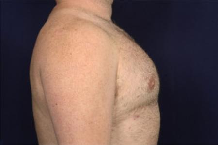 After image 3 Case #102481 - Gynecomastia