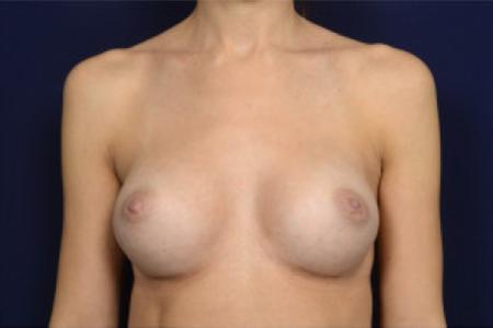 After image 1 Case #102746 - Breast Augmentation