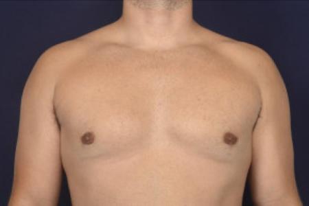 After image 1 Case #102536 - Gynecomastia