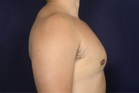 After image 3 Case #102536 - Gynecomastia