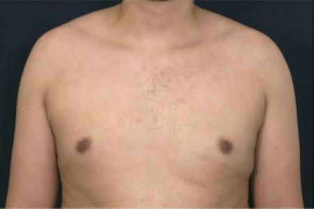 After image 1 Case #102366 - Gynecomastia