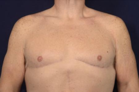 After image 1 Case #102431 - Gynecomastia