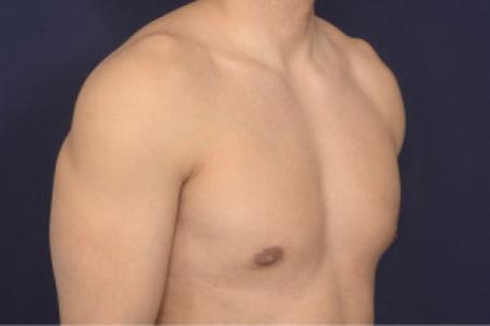 After image 2 Case #102411 - Gynecomastia