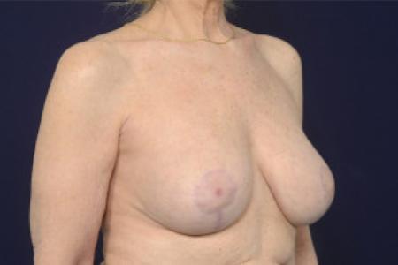 After image 2 Case #102511 - Breast Augmentation Revision