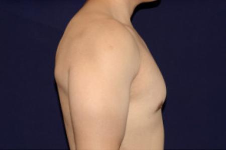 After image 3 Case #102731 - Gynecomastia