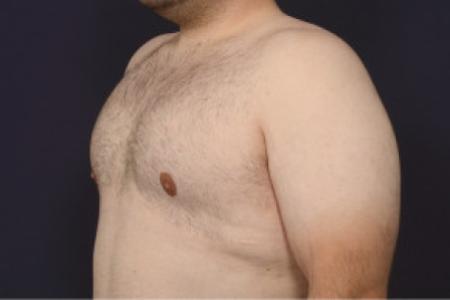 After image 2 Case #102626 - Gynecomastia
