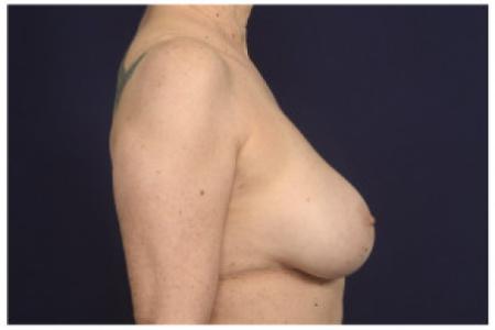 After image 3 Case #102336 - Breast Augmentation Revision