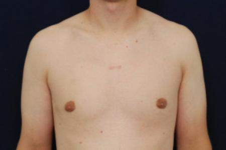 After image 1 Case #102656 - Gynecomastia