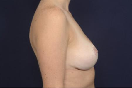 After image 3 Case #102471 - Breast Reduction